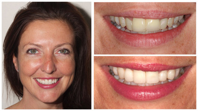 Les dents de Marie avant et après le traitement